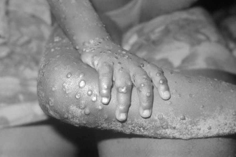 About Monkey Pox